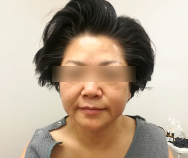 After：施術後の状態