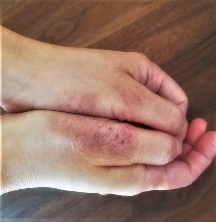 Before：施術前の状態